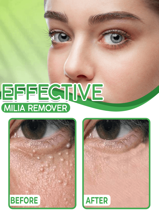 Eye Milia Removal Cream